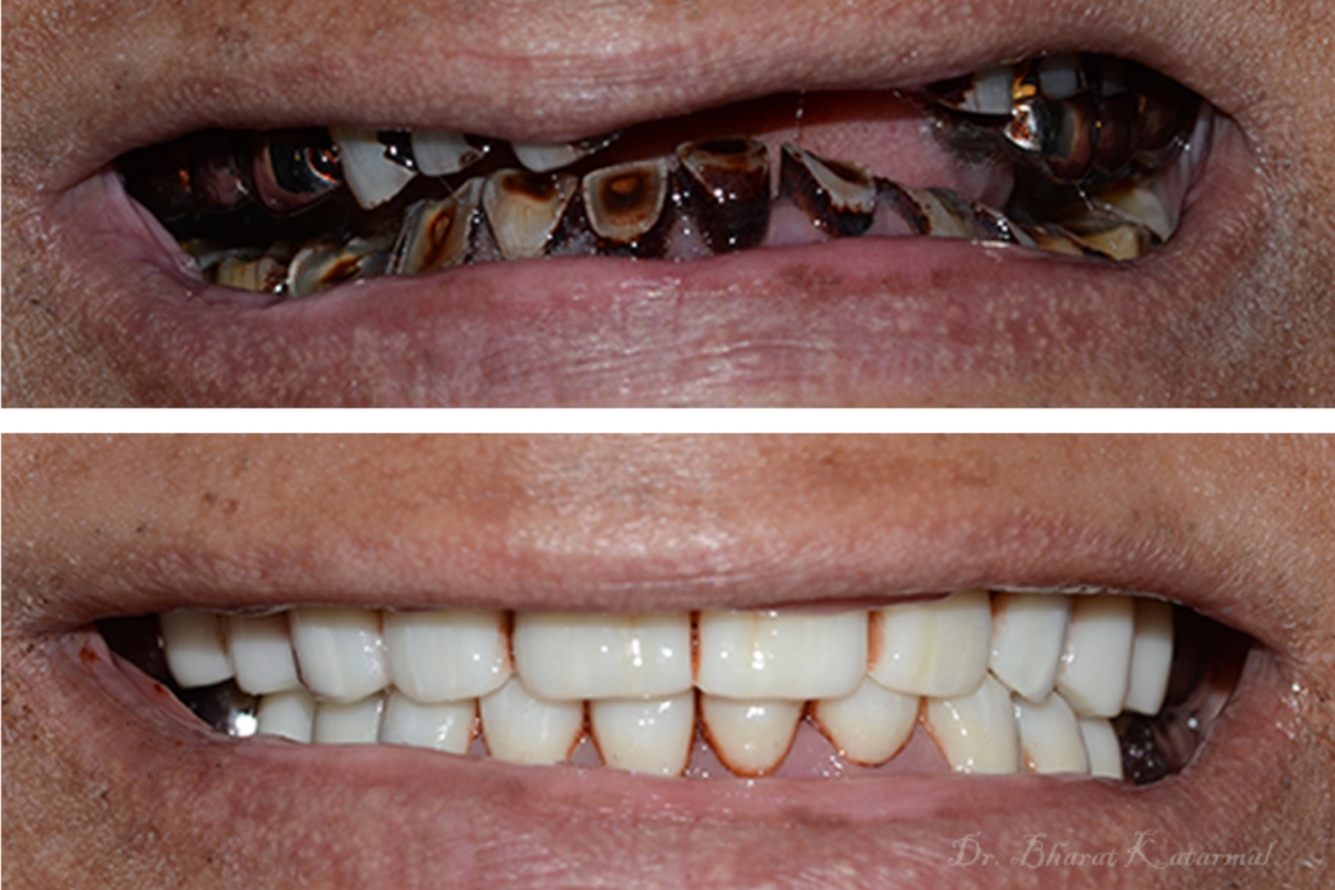 Prosthodontics & Geriatric Dentistry